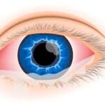 Allergic Conjunctivitis Market Report Forecasts Dynamic Growth Through 2035