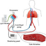 Extracorporeal Membrane Oxygtioenan ECMO System Market Report Forecasts Dynamic Growth Through 2035