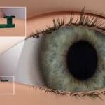 Glaucoma Therapeutics Market Report Forecasts Dynamic Growth Through 2035