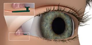 Glaucoma Therapeutics Market Report Forecasts Dynamic Growth Through 2035