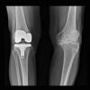 Knee Replacement Market Report Forecasts Dynamic Growth Through 2035