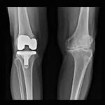 Knee Replacement Market Report Forecasts Dynamic Growth Through 2035
