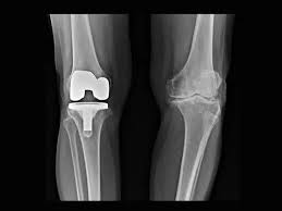 Knee Replacement Market Report Forecasts Dynamic Growth Through 2035 Knee Replacement Market Report Forecasts Dynamic Growth Through 2035