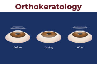 Orthokeratology Contact Lens Market Report Forecasts Dynamic Growth Through 2035