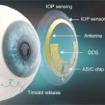 Smart Contact Lenses Market Report Forecasts Dynamic Growth Through 2035