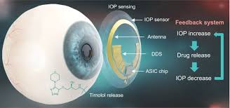 Smart Contact Lenses Market Report Forecasts Dynamic Growth Through 2035