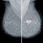 China Breast Imaging Market Forecast: Global Growth Outlook till 2035