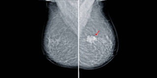 China Breast Imaging Market Forecast: Global Growth Outlook till 2035