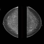 Japan Breast Cancer Imaging Market Research Report: Trends, Insights, and Forecast 2035