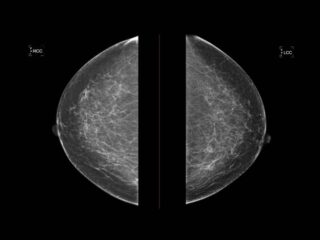 Japan Breast Cancer Imaging Market Research Report: Trends, Insights, and Forecast 2035