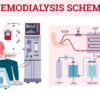 Haemodialysis Concentrates Market Study: Comprehensive Segmentation and Forecast