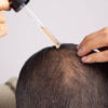 Japan Alopecia Treatment Market Insights: Regional and Segmental Analysis