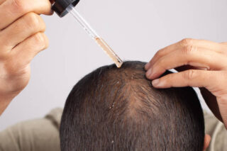 Japan Alopecia Treatment Market Insights: Regional and Segmental Analysis