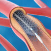 US Metal Stents Market Size, Share, Growth Drivers Report 2035
