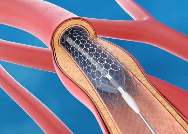 US Metal Stents Market Size, Share, Growth Drivers Report 2035