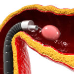 Europe Minimally Invasive Spine Technologies Market Trends and Strategic Analysis 2025–2035