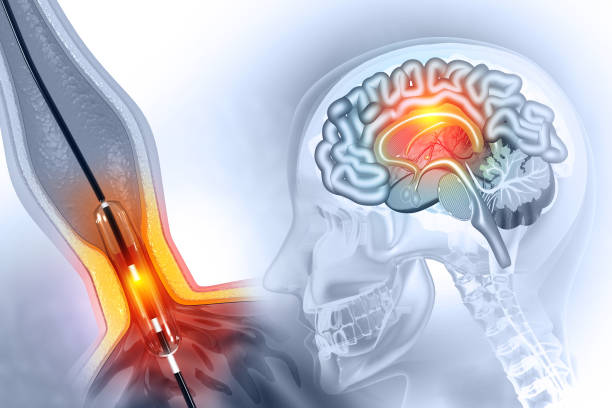 US Neuroendoscopy Market Outlook 2025–2035: Trends and Forecast