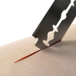 Skin Graft Blades Market Dynamics: Regional Breakdown and Analysis