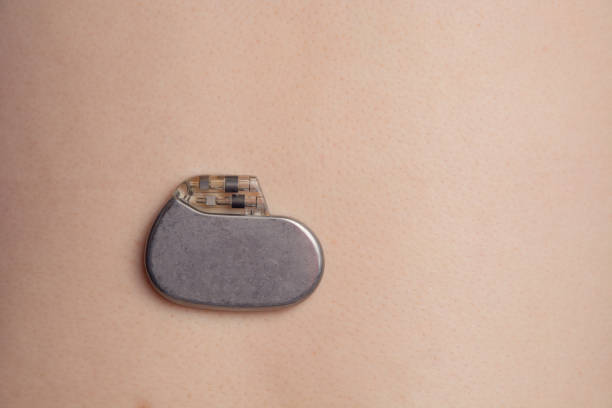 Japan Implantable Pulse Generator Market Research Report: Trends, Insights, and Forecast 2035
