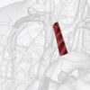 US Inferior Vena Cava (IVC) Filter Market Size, Share, Growth Drivers Report 2035