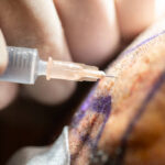 Japan Post Anaesthesia Care Unit Device (PACU) Market Trends and Strategic Analysis 2025–2035