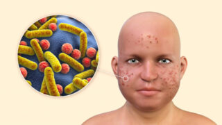 Europe Hereditary Angioedema Market Size & Revenue Analysis 2035