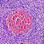 Europe Malignant Peripheral Nerve Sheath Tumour Treatment Market Insights: Regional and Segmental Analysis