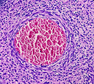 Europe Malignant Peripheral Nerve Sheath Tumour Treatment Market Insights: Regional and Segmental Analysis