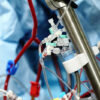 China Veno-Arterial ECMO System Market Outlook 2025–2035: Trends and Forecast
