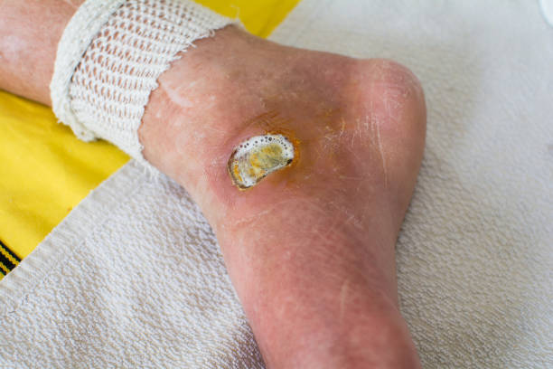 Europe Diabetic Foot Ulcers Treatment Market Size & Revenue Analysis 2035