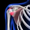 US Shoulder Support Market Industry Analysis, Size, and Demand Forecast