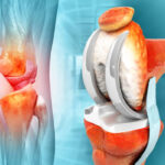 china Artificial Implants Market Industry Forecast: Navigating the Trade-Off Era Amid Global Economic Uncertainty