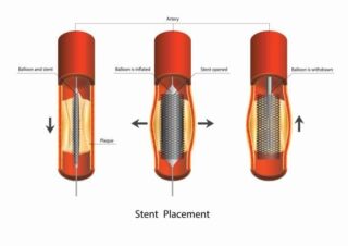 china Stents and Related Implants Market Outlook 2025: Forecasting Growth in a Time of Economic and Policy Shifts