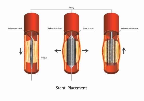 china Stents and Related Implants Market Outlook 2025: Forecasting Growth in a Time of Economic and Policy Shifts